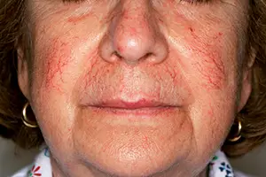 laserbehandeling-vaatjes-1