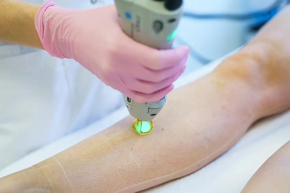 laserbehandeling ontharen breda htc