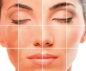 microneedling