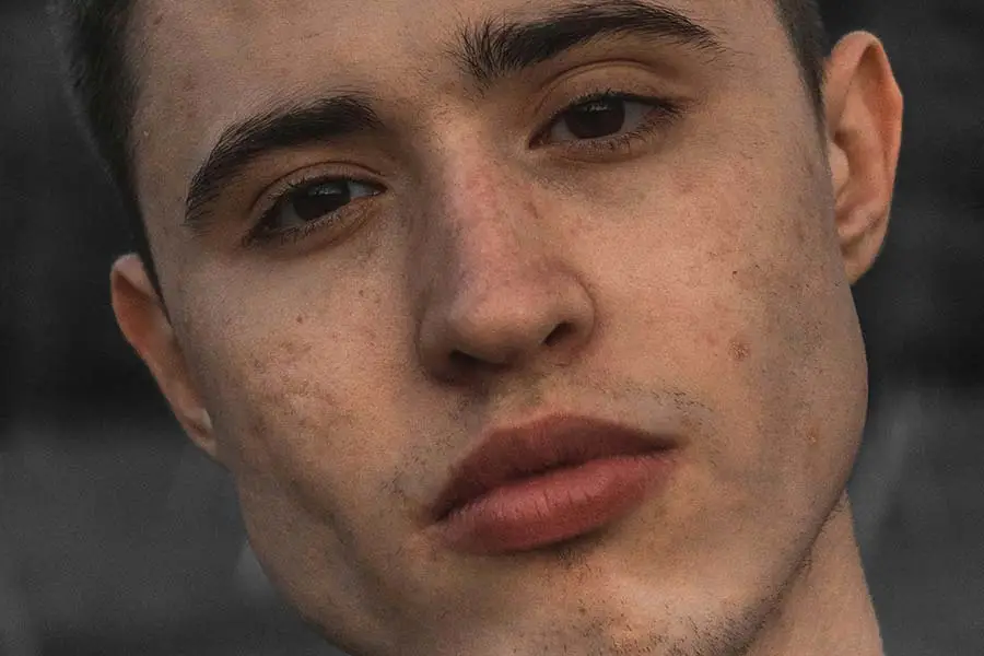 acne littekens wat te doen