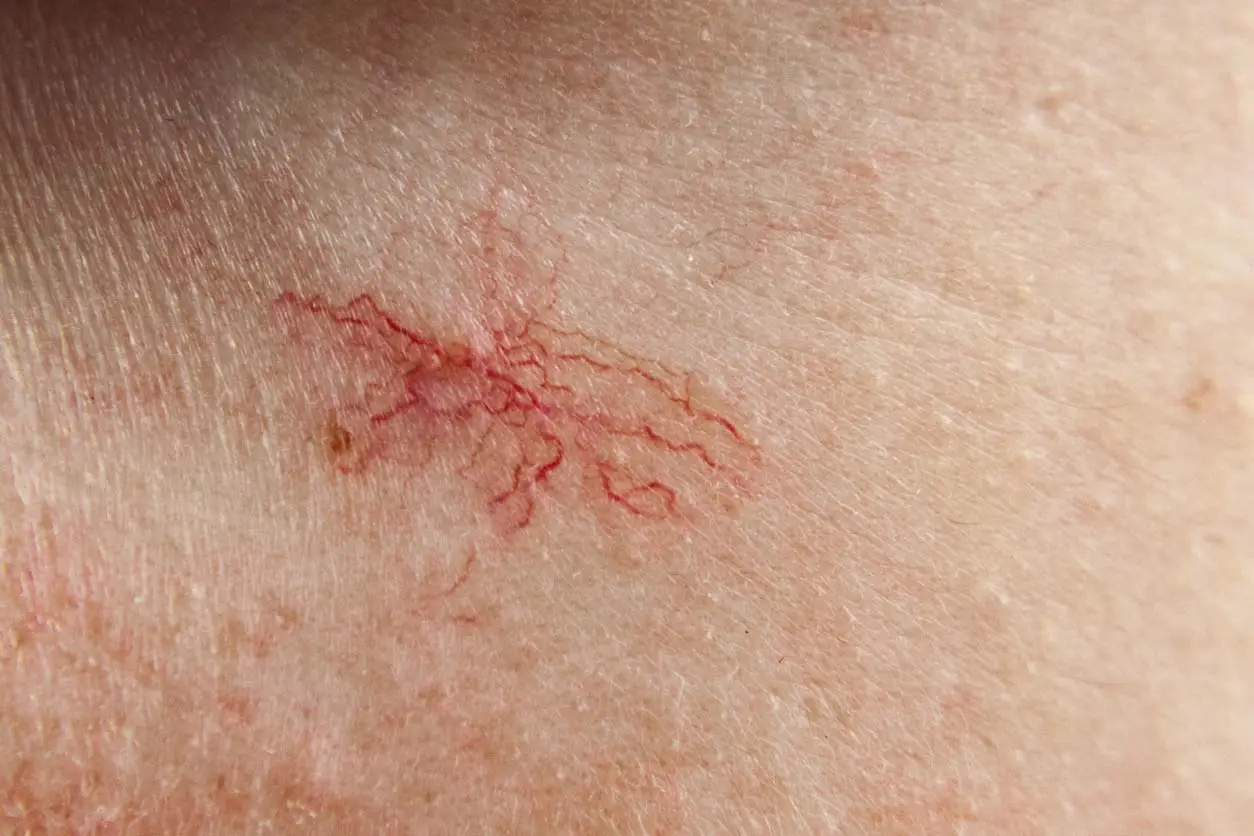 wat kun je behandelen met de vaatlaser